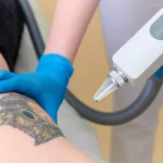 Tattoo Removal