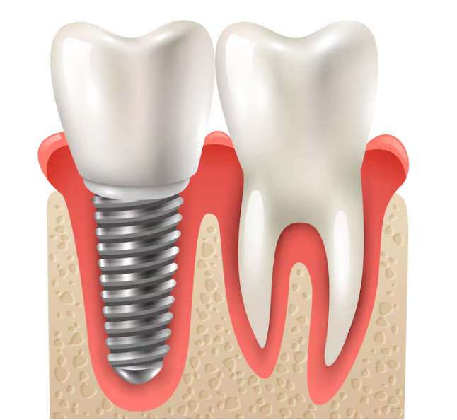 What Makes Lakeview Dental the Best Choice for Dental Implants?