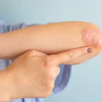 Psoriasis