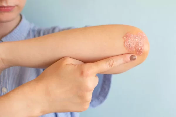 Psoriasis