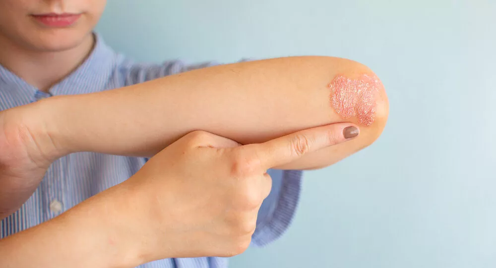 Psoriasis